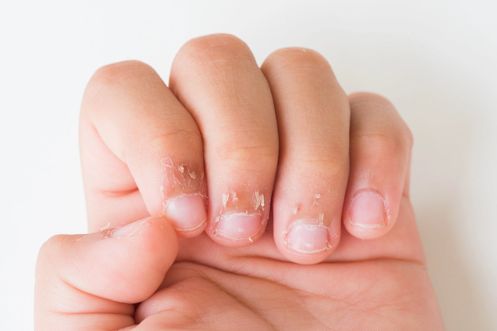 ragged nails and dry cuticles |From Ragged to Radiant: Essential Tips for Reviving Your Nails | Parisians Pure Skincare