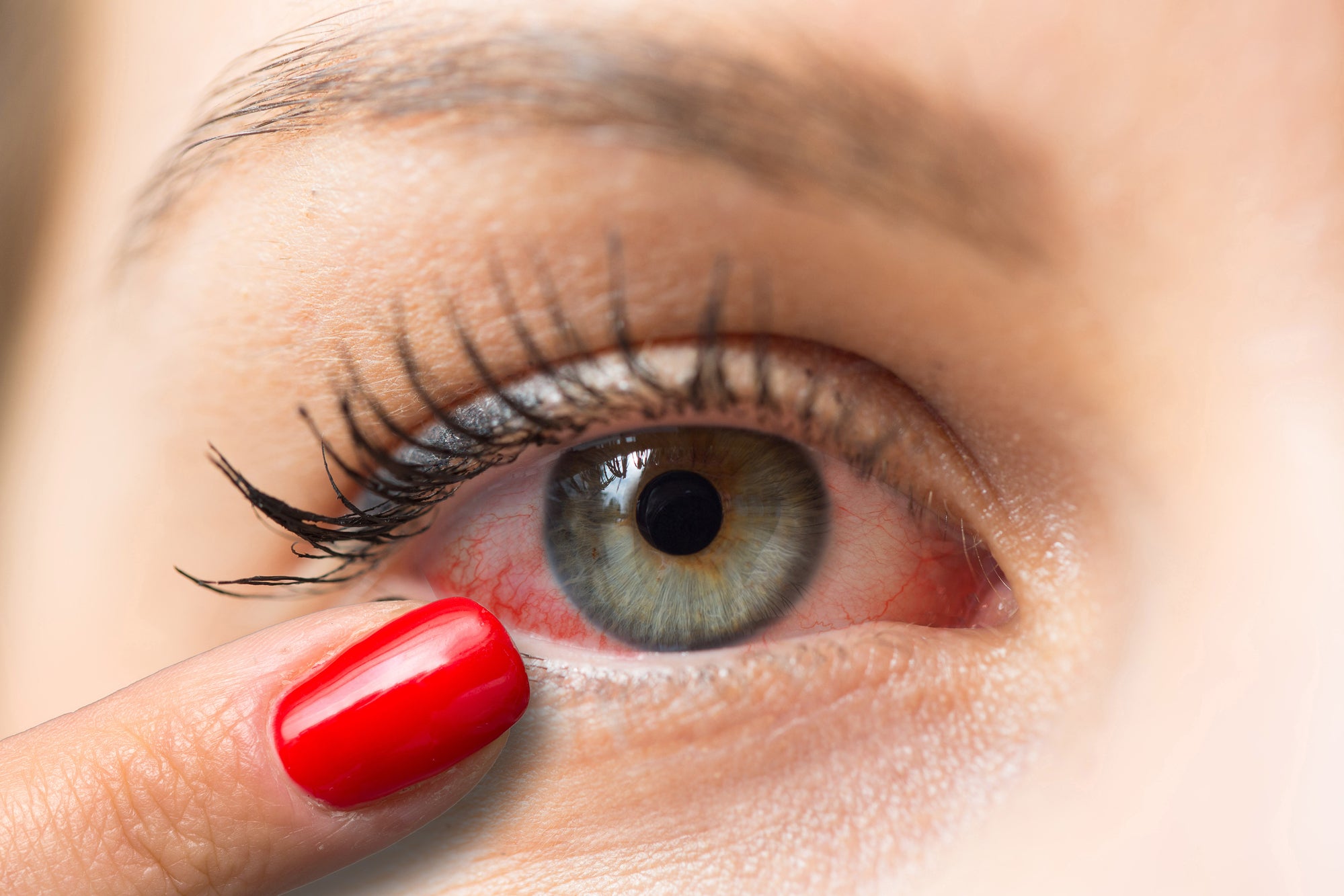 7 Common Eye Cream Ingredients That Can Cause Allergies | Woman with red irritated eyes